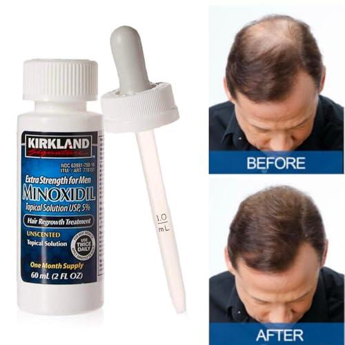 Reviving Our Crown:⁣ A ​6-Month Journey with Kirkland Minoxidil