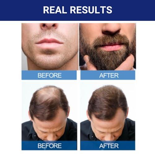 Reviving ‍Our Crown: A ‍6-Month Journey with ⁣Kirkland Minoxidil