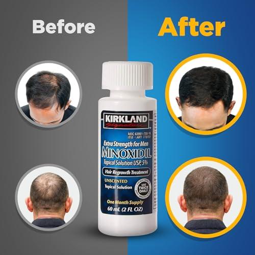 Reviving ⁣Our Crown: A 6-Month Journey with Kirkland ⁣Minoxidil